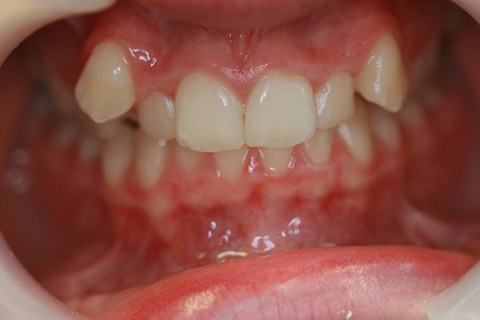 Comprehensive Orthodontics - Before Treatment