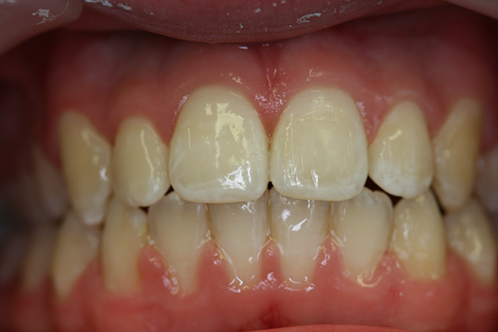 Comprehensive Orthodontics - After Treatment