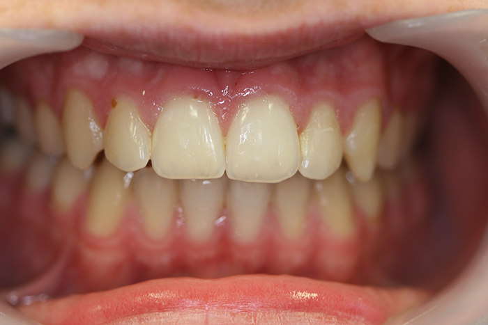Short Term Orthodontics - After Treatment
