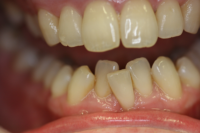 Short Term Orthodontics - Before Treatment