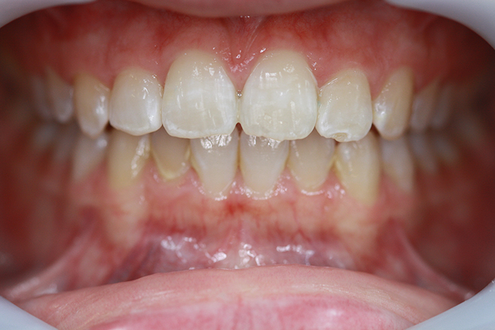 Short Term Orthodontics - After Treatment